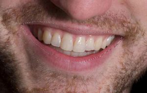 سفید کردن دندانها در فتوشاپ
